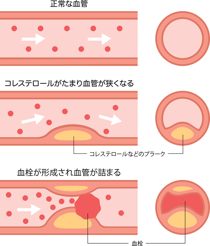 狭心症の原因は動脈硬化！？